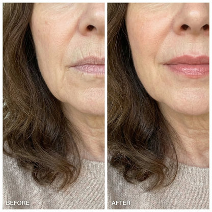 Kiss Me™ Red Light Lip Therapy